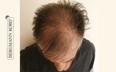 metamosxefsi-malliwn-apotelesmata-andres-41001PG-index