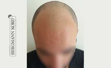 metamosxefsi-malliwn-apotelesmata-andres-46002PG-index