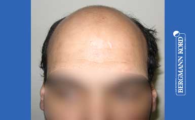 metamosxefsi-malliwn-apotelesmata-andres-51024PG-index