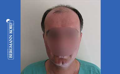 metamosxefsi-malliwn-apotelesmata-andres-57030PG-index