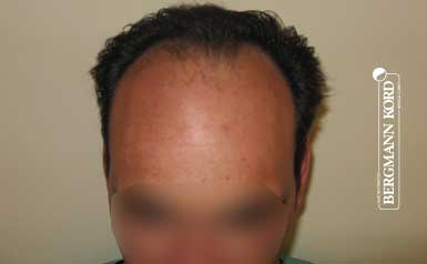 metamosxefsi-malliwn-apotelesmata-andres-58025PG-index