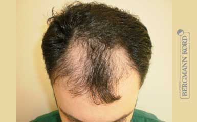 metamosxefsi-malliwn-apotelesmata-andres-61011PG-index