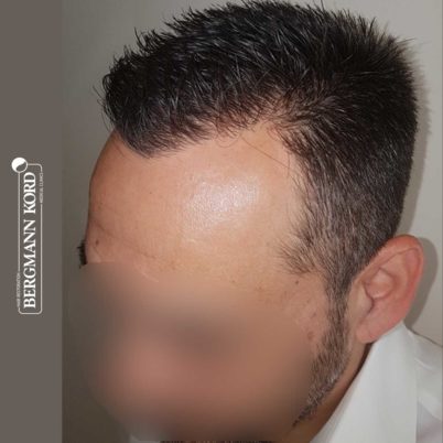 metamosxefsi-malliwn-apotelesmata-FUE-56047TL-10-months-later-left