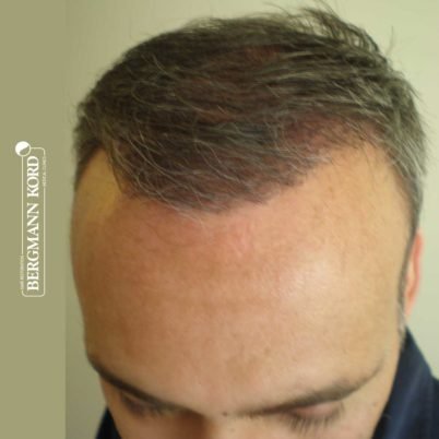 metamosxefsi-malliwn-apotelesmata-FUT-66029TL-3-months-hairline