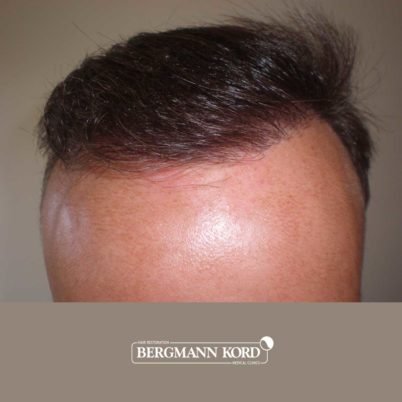 metamosxefsi-malliwn-apotelesmata-FUT-66029TL-7-months-hairline