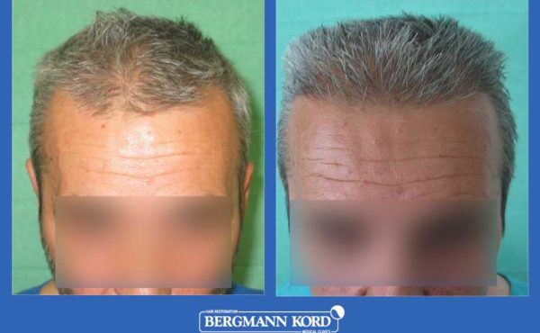 metamosxefsi-malliwn-bergmann-kord-apotelesmata-andres-mtm-fue-prin-meta-28776PG-001