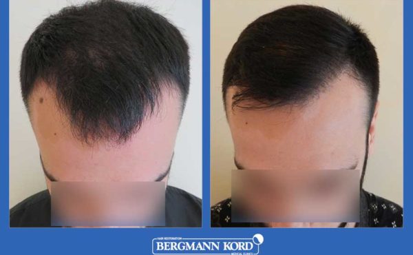 metamosxefsi-malliwn-bergmann-kord-apotelesmata-andres-mtm-fue-prin-meta-69021PG-001