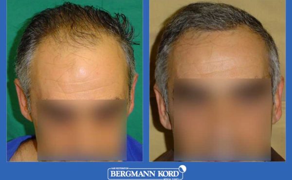 metamosxefsi-malliwn-bergmann-kord-apotelesmata-andres-mtm-fut-prin-meta-19089PG-001