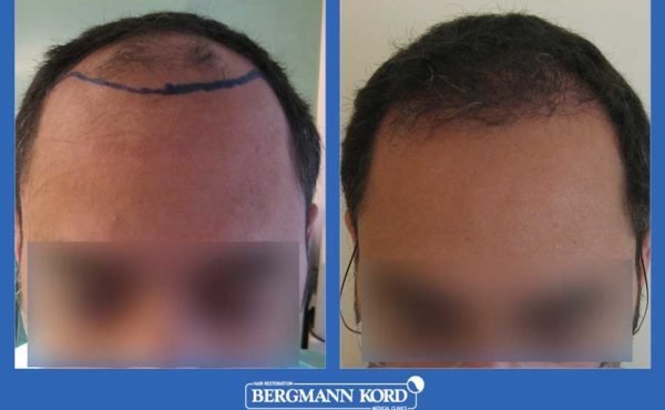 metamosxefsi-malliwn-bergmann-kord-apotelesmata-andres-mtm-fut-prin-meta-22320PG-001