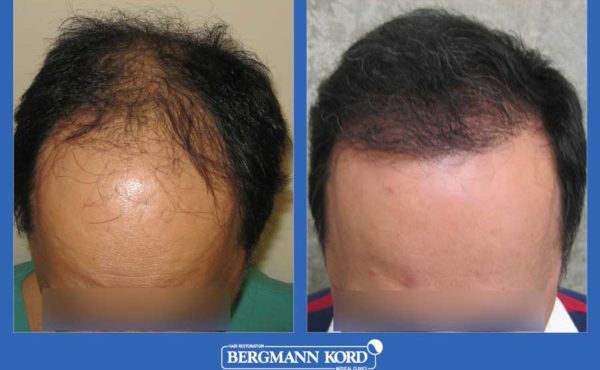 metamosxefsi-malliwn-bergmann-kord-apotelesmata-andres-mtm-fut-prin-meta-26308PG-001