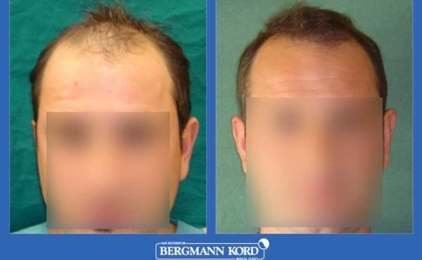 metamosxefsi-malliwn-bergmann-kord-apotelesmata-andres-mtm-fut-prin-meta-28307PG-001