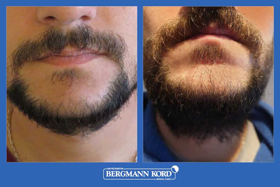 hair-implantation-bergmann-kord-results-men-17561PG-before-after-001