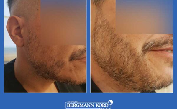 hair-implantation-bergmann-kord-results-men-45045PG-before-after-001