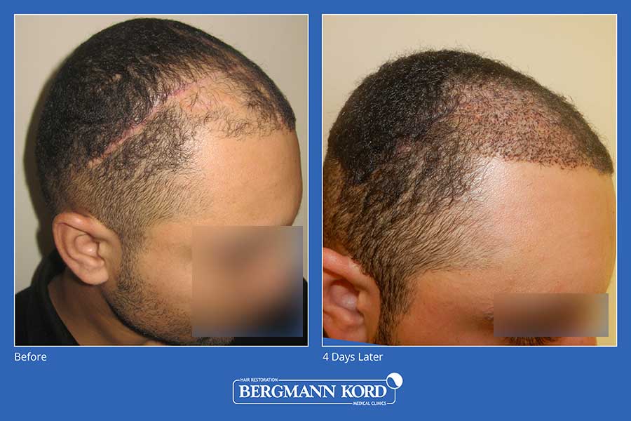 hair-implantation-bergmann-kord-results-men-45101PG-before-after-001