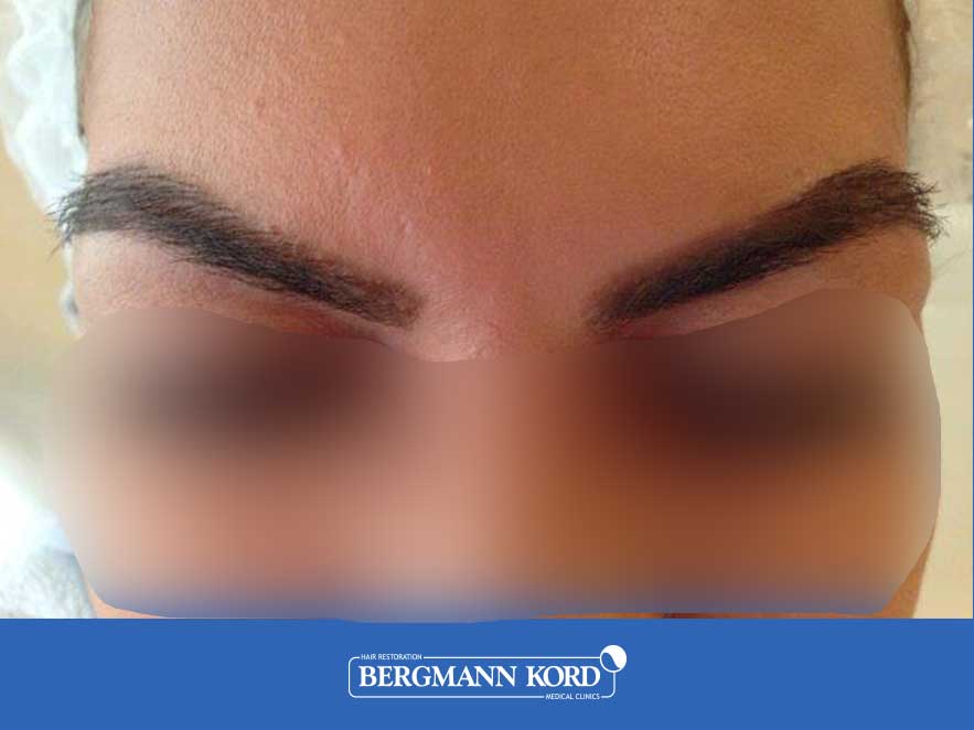 hair-implantation-bergmann-kord-results-woman-45040PG-after-front-001