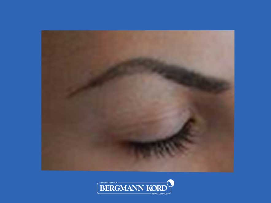hair-implantation-bergmann-kord-results-woman-45040PG-before-zoom-left-001