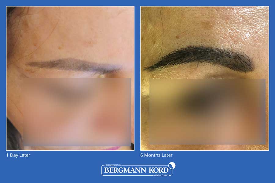 hair-transplantation-bergmann-kord-hair-clinics-eyebrow-implantation-photo-slider-01-002