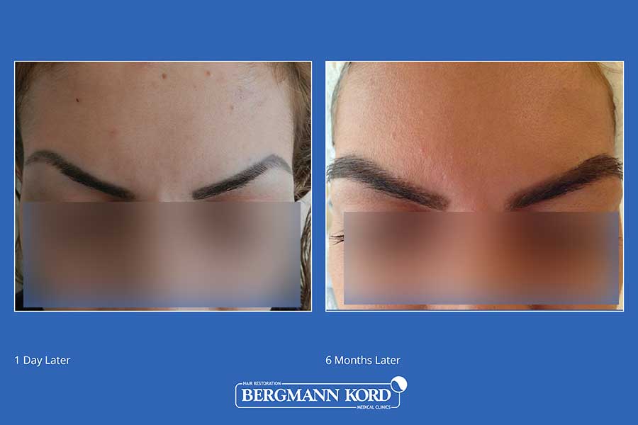 hair-transplantation-bergmann-kord-hair-clinics-eyebrow-implantation-photo-slider-01-004