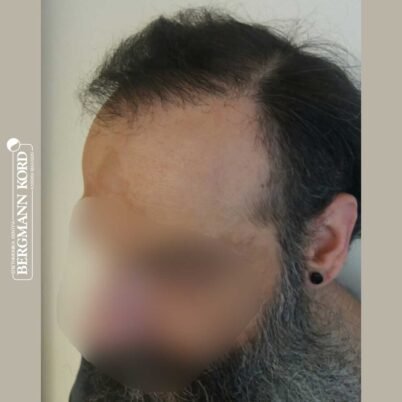 hair-transplantation-bergmann-kord-results-57005TL-6months-left-001