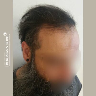 hair-transplantation-bergmann-kord-results-57005TL-6months-right-001