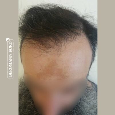 hair-transplantation-bergmann-kord-results-57005TL-6months-top-001