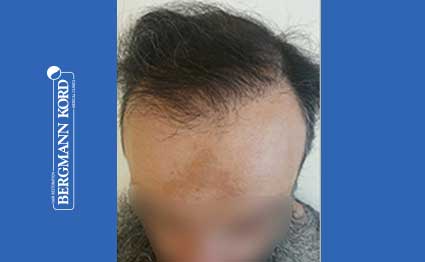 hair-transplantation-bergmann-kord-results-57005TL-after-001