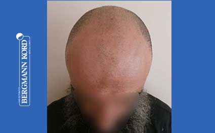 hair-transplantation-bergmann-kord-results-57005TL-before-001