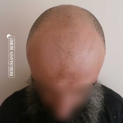 hair-transplantation-bergmann-kord-results-57005TL-before-top-001