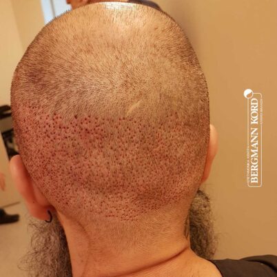 hair-transplantation-bergmann-kord-results-57005TL-this-day-donor-area-001