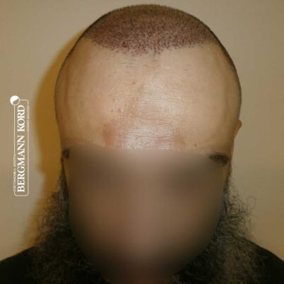 hair-transplantation-bergmann-kord-results-57005TL-this-day-front-001