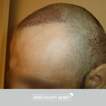 hair-transplantation-bergmann-kord-results-57005TL-this-day-left-001