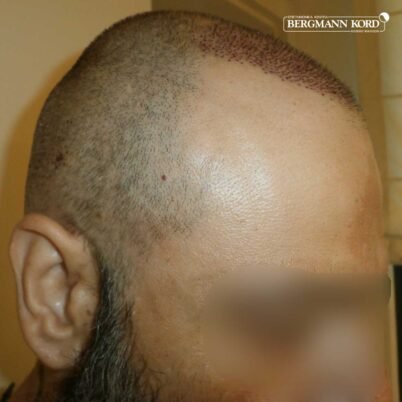 hair-transplantation-bergmann-kord-results-57005TL-this-day-right-001