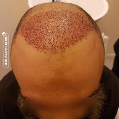 hair-transplantation-bergmann-kord-results-57005TL-this-day-top-001