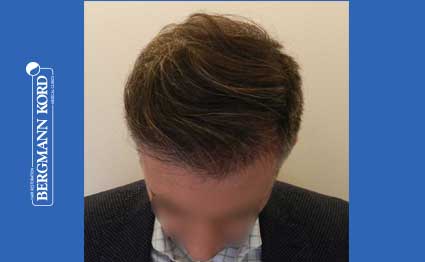 hair-transplantation-bergmann-kord-results-FUE-41001TL-after-001