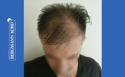 hair-transplantation-bergmann-kord-results-FUE-41001TL-before-001