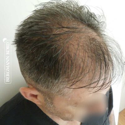 hair-transplantation-bergmann-kord-results-FUE-41001TL-before-left-001