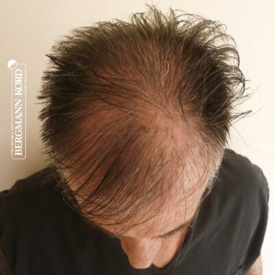 hair-transplantation-bergmann-kord-results-FUE-41001TL-before-top-001