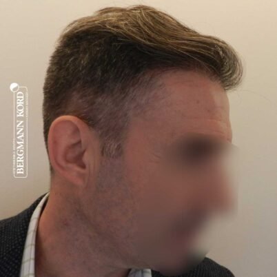 hair-transplantation-bergmann-kord-results-FUE-41001TL-left-001