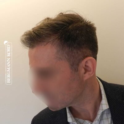 hair-transplantation-bergmann-kord-results-FUE-41001TL-right-001