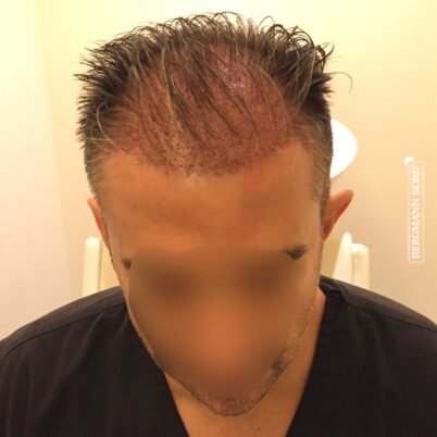 hair-transplantation-bergmann-kord-results-FUE-41001TL-this-day-front-001