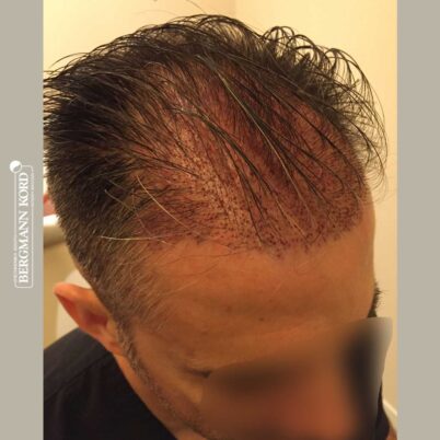 hair-transplantation-bergmann-kord-results-FUE-41001TL-this-day-right-001