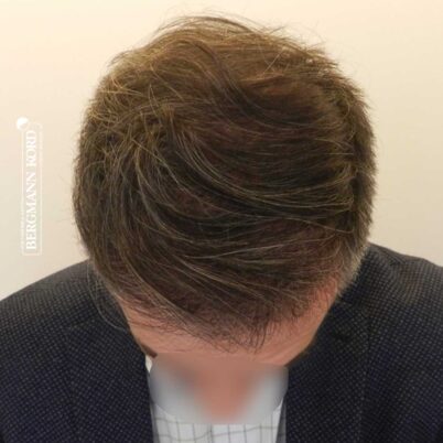 hair-transplantation-bergmann-kord-results-FUE-41001TL-top-001