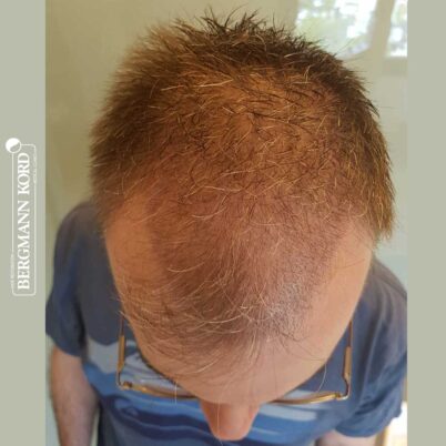 hair-transplantation-bergmann-kord-results-FUE-49048TL-10-day-later-001