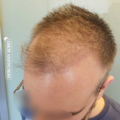 hair-transplantation-bergmann-kord-results-FUE-49048TL-10-day-later-left-001
