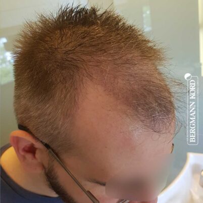 hair-transplantation-bergmann-kord-results-FUE-49048TL-10-day-later-right-001