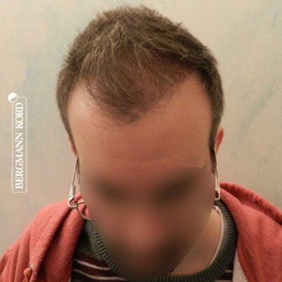 hair-transplantation-bergmann-kord-results-FUE-49048TL-3-months-later-001