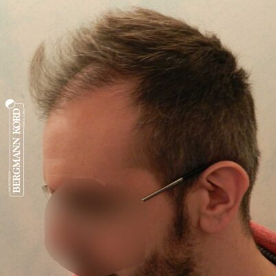 hair-transplantation-bergmann-kord-results-FUE-49048TL-3-months-later-left-001