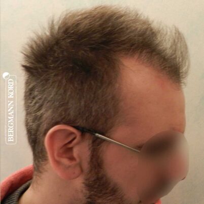 hair-transplantation-bergmann-kord-results-FUE-49048TL-3-months-later-right-001