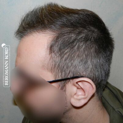 hair-transplantation-bergmann-kord-results-FUE-49048TL-6-months-later-left-001