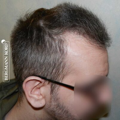 hair-transplantation-bergmann-kord-results-FUE-49048TL-6-months-later-right-001